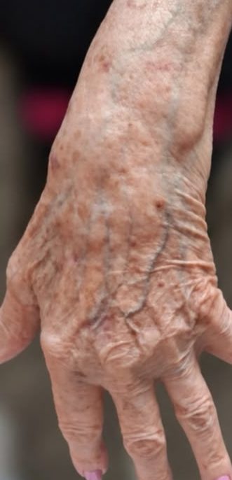 Antes: dorso da mão com manchas, antes do peeling químico.